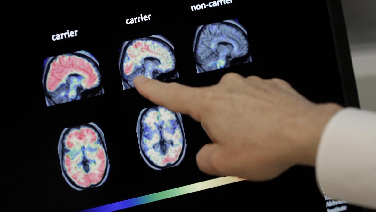 Diabetes, hearing loss among key factors for dementia in India; women more prone to it: study